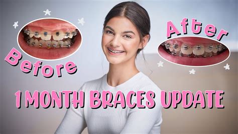 One Month Braces (How Teeth Move In One Month .